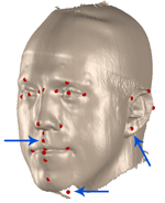 Failure case of landmark registration: Ear, mouth and missing parts in the scan may lead to misregistration.